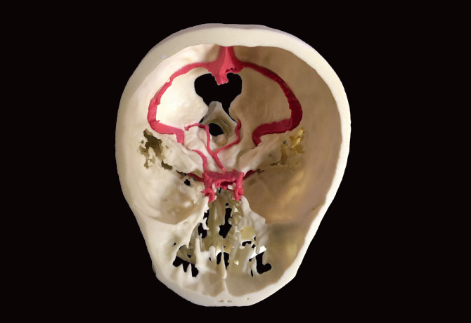 A image of a 3D printed model for endoscopic odontoidectomy.