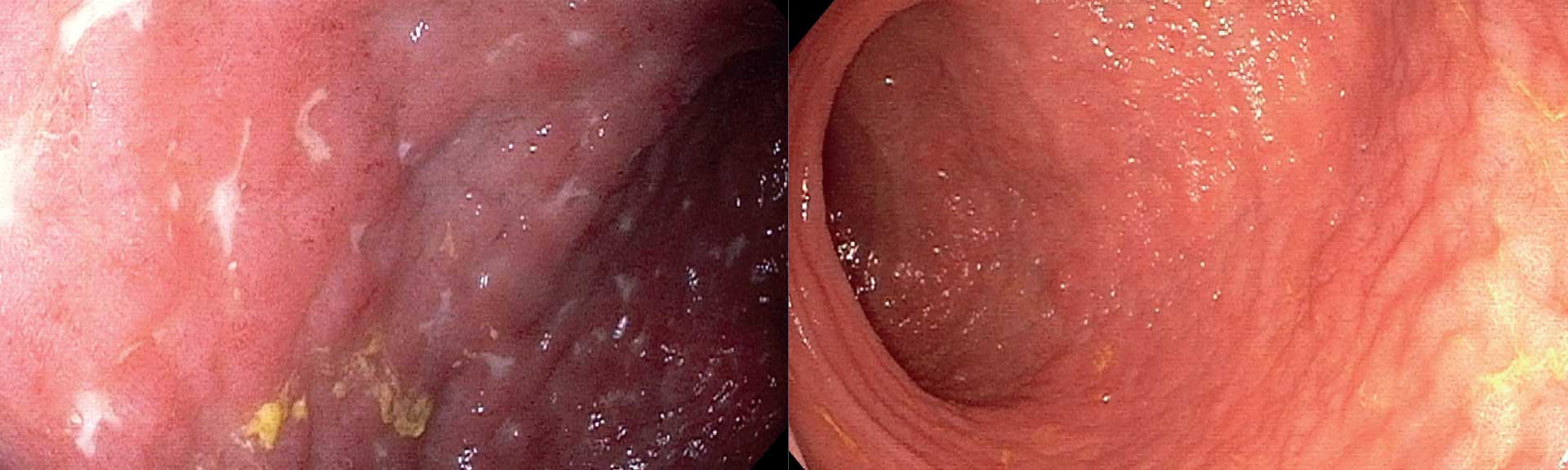 gastro