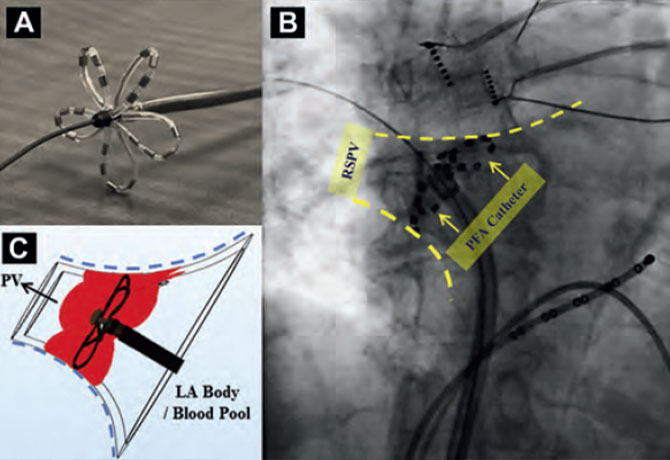 Three images show: In the first image, the fully deployed endocardial pulsed field ablation (PFA) catheter is shown over a guidewire as it exits the transseptal sheath. In the second image, an in vivo fluoroscopic view depicts the fully deployed ablation catheter positioned at the right superior pulmonary vein (PV) ostium. The PV is outlined by contrast injection performed through the sheath. Pacing catheters in the coronary sinus and right ventricular apex are also present. In the third image, a model of a PFA zone. In this cross-sectional, long-axis view of the left atrium-PV junction, the shaded red area represents the circumferential ablation zone