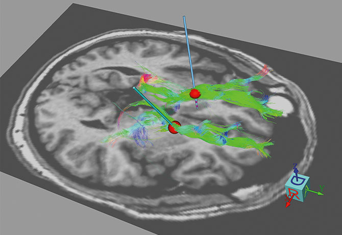 An Image shows individualized model of DBS target (shown by a red dot) for obsessive-compulsive disorder and impacted circuit and associated fiber bundles. Red dot represents the volume of tissue activated by estimated therapeutic stimulation dose.