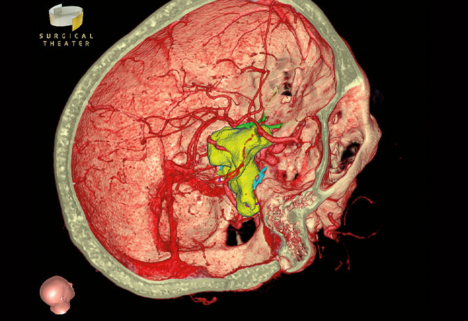 Figure 1: The patient-specific 3D simulation displays the tumor in yellow, the vessels in red, cranial nerves in blue/magenta, and optic nerve in green.