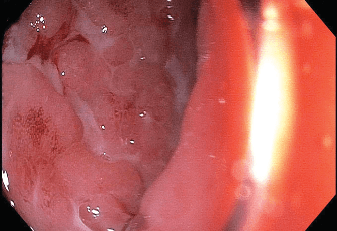 An image shows descending colon with deep linear ulcerations, bleeding, and exudate.