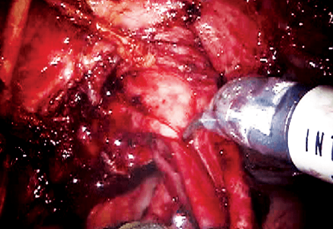 An image shows extravesical posterior dissection of the duplex system and ureterocele prior to intravesical excision and bladder neck reconstruction.