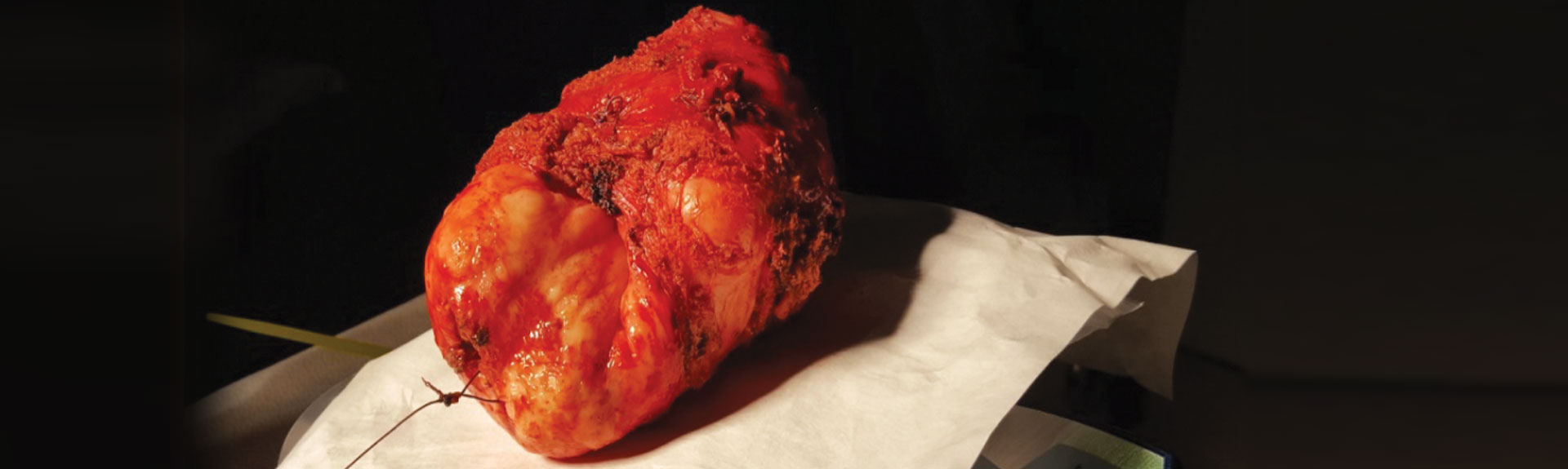 A photo of the prostate after it was removed, which weighed 426 grams