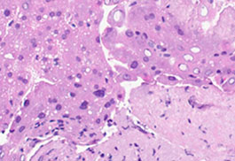 The Tisch Cancer Institute