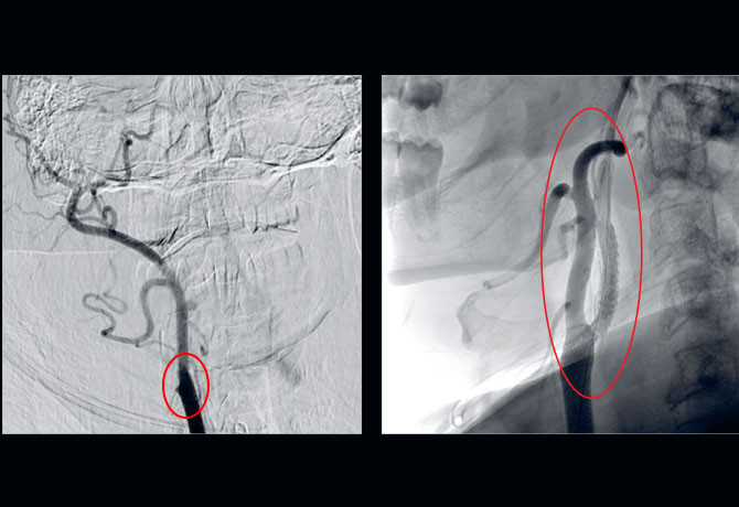 Image of Digital subtraction angiography