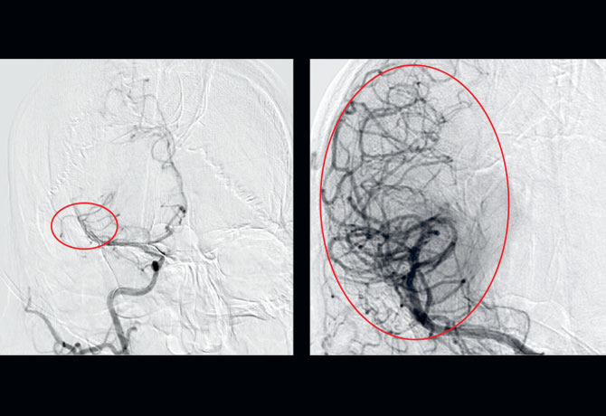 Image of Digital Subtraction Angiography