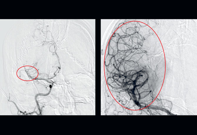 Image of Digital Subtraction Angiography