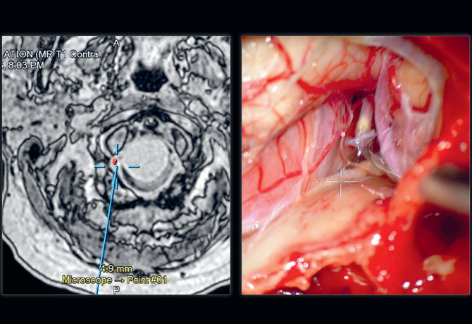 Image of Integration of intraoperative navigation and microscope