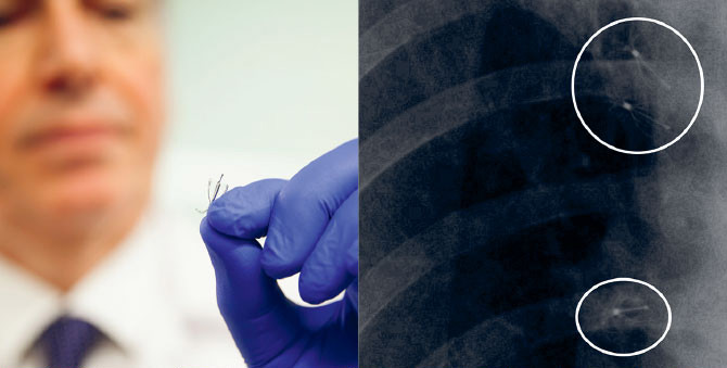 Image of doctor holding lung valves