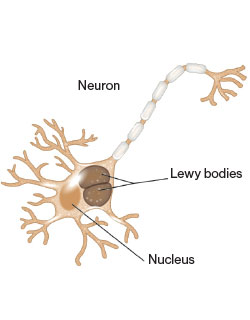 Image shows Lewy bodies in traumatic brain injury with a loss of consciousness