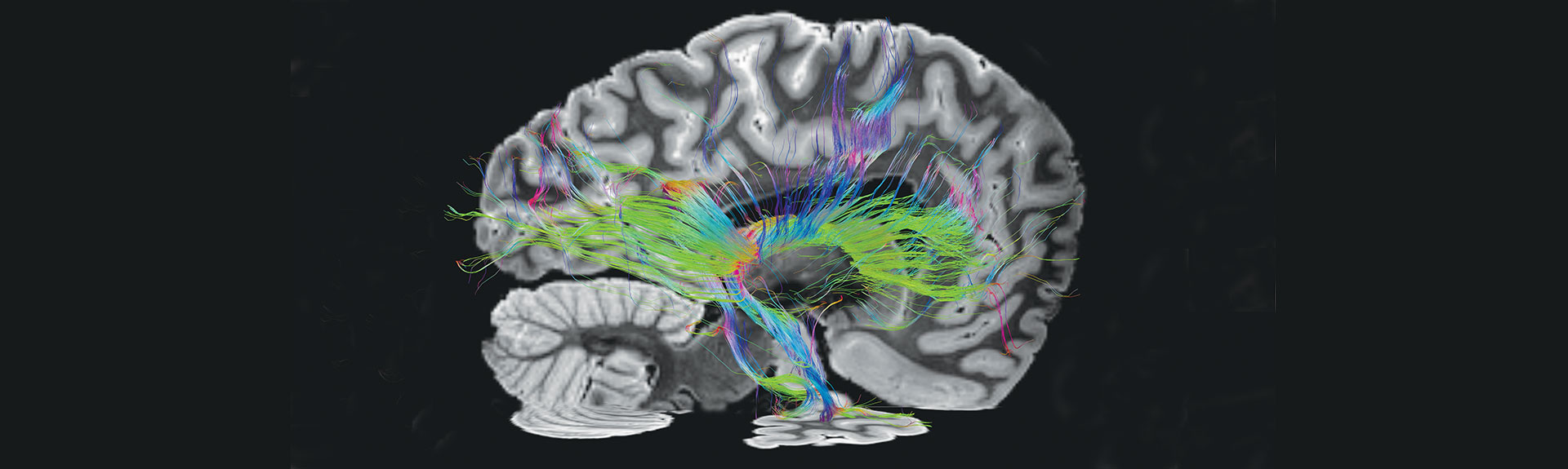 Right lateral view of thalamocortical fiber tracts from ex-vivo MRI taken on an individual with a history of traumatic brain injury