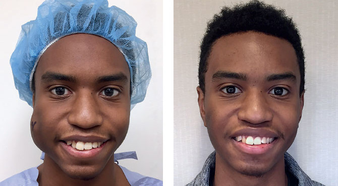 A photo showing Ethan Garcia (left) before surgery and (right) one month after the removal of his vascular malformation.