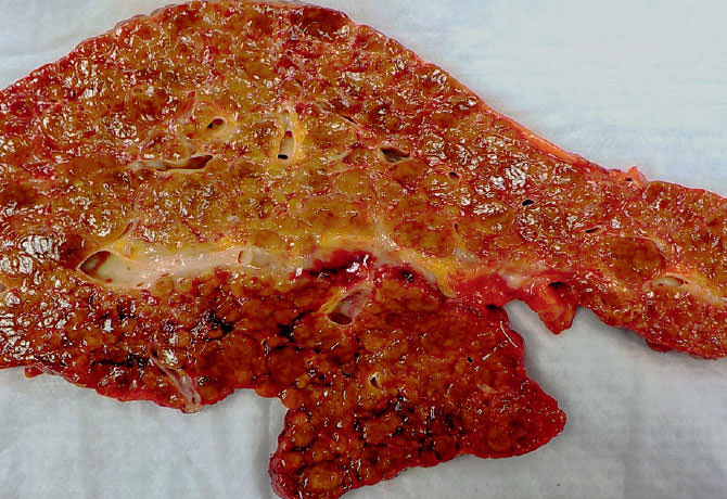 liver with nonalcoholic steatohepatitis (NASH)-induced cirrhosis