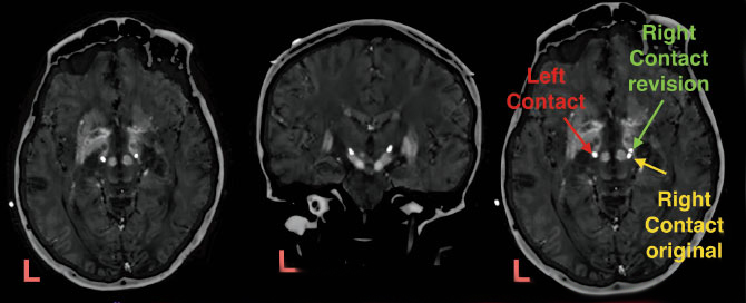 Axial and coronal postoperative images demonstrate satisfactory caudal zona incerta electrode placement