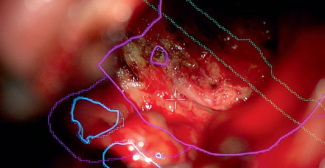A heads-up display image during surgery outlining the tumor as the pathology and the vessels in blue and green