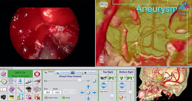 Image of intraoperative view of tracked endoscope and simulation navigation in real time with tracked instrument
