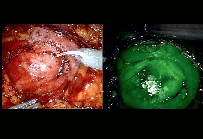 Two images show isthmus of the horseshoe kidney