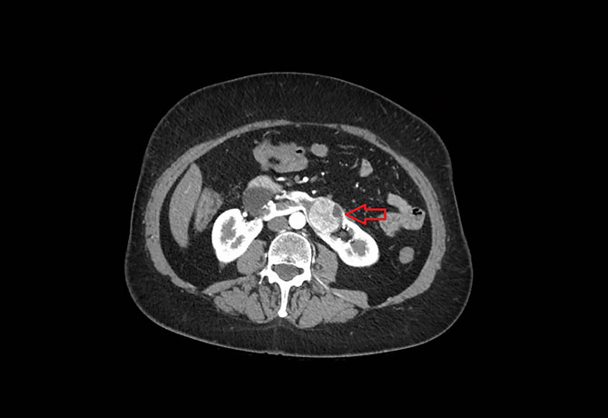 Image of the midline isthmus of the horseshoe kidney with an arrow pointing out the endophytic tumor.