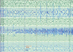 image of preoperative stereo-EEG