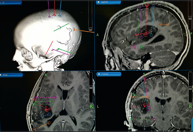 image of preoperative stereo-EEG