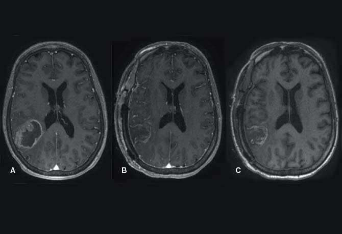 image of  preoperative MRI scans