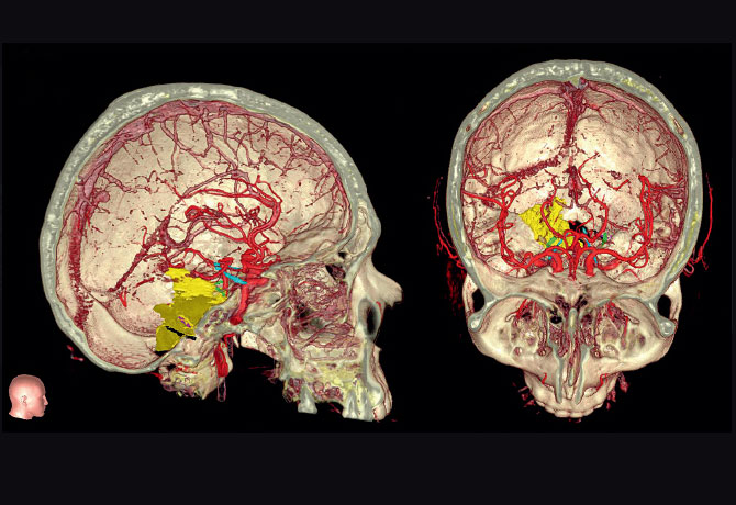 Image of a 3D representation of anatomy using MRI and CTA