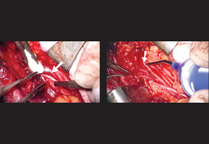 An image taken through the operating microscope shows the neurolysis, or scar-cleaning, procedure