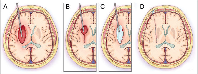 image of a hemorrhage