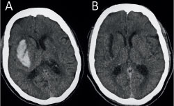 image of two brain scans