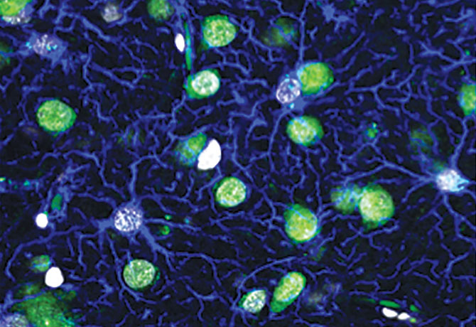 An immunoﬂuorescence imaging of brain cells at a seizure focus that were surgically removed from a patient with medically intractable temporal lobe epilepsy.