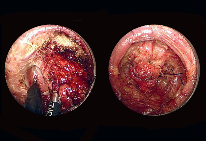 Image of rectum dissected inside out 