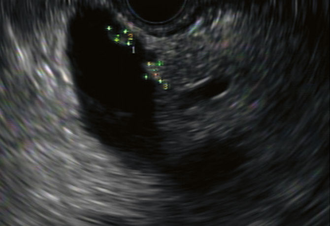 EUS image from patient Martin Abrams, showing the dominant pancreatic cyst with two intramural nodules