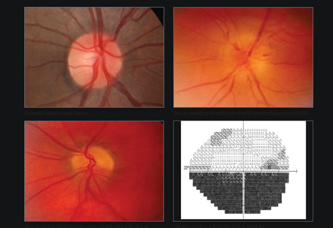 One image shows normal healthy optic nerve; Second image shows acute swelling of optic nerve with hemorrhages in NAION; Third image shows resolved swelling of optic nerve in NAION. Takes 4-6 weeks for swelling to resolve. Swelling replaced by pale appearance and damage to nerve; Fourth image shows inferior peripheral vision loss in NAION.