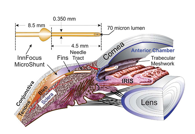 A diagram showing InnFocus MicroShunt is designed to shunt aqueous fluid from anterior chamber to sub-conjunctival/sub-Tenon’s of the eye.