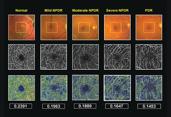 An image of the OCT angiography comparison study used to quantify clinical retinal perfusion.