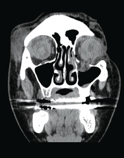A CT scan of coronal image of the left orbit 