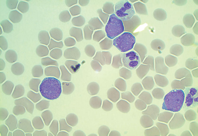 An image of the peripheral blood smear shows four blasts: very large cells with a large immature purple nucleus and small rim of blue cytoplasm.