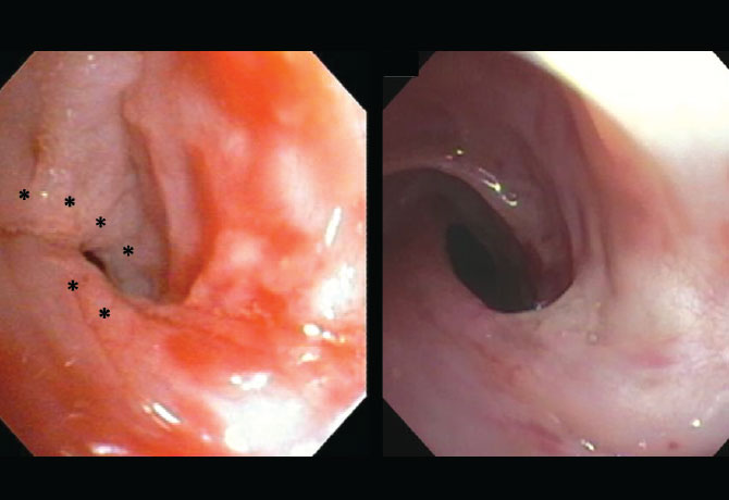 A pre-treatment bronchoscopic view of the left main bronchus, demonstrating a congenital spiral-shaped web obstructing the airway. Prior balloon dilation procedures failed to maintain patency of the airway due to recurrent scarring. (Markings denote approximate areas of treatment.) A post-cryotherapy treatment view of the same area, demonstrating partial involution of the web without residual scarring.