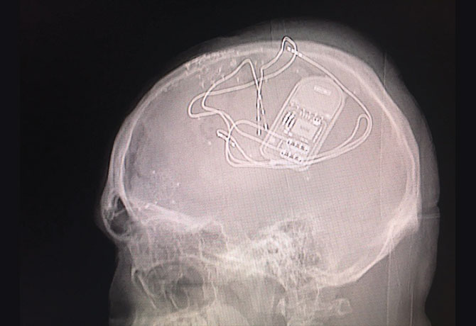 Postoperative X-ray showing the responsive neurostimulator connected to depth electrodes in the bilateral-movement areas of the brain.