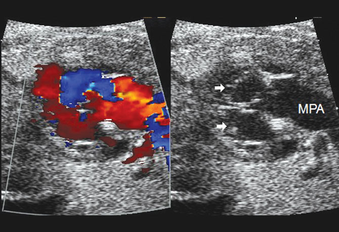 One image shows gray scale and corresponding color flow mapping frames at 31 weeks gestation in fetal echocardiogram. A second image shows single left ventricle entered by both the mitral and tricuspid valves open in diastole (arrows) cut as circles with a large main pulmonary artery leaving the outlet (MPA). The red and blue colors map the direction of blood flow with respect to the probe. Brightness of hue α flow velocity.