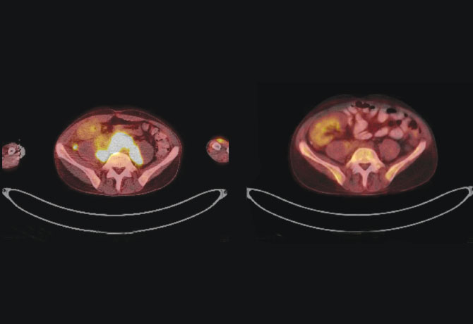 A preop PET/CT shows the tumor under the kidney transplant arching near the spine. A postop PET/CT shows resolution of the primary tumor.