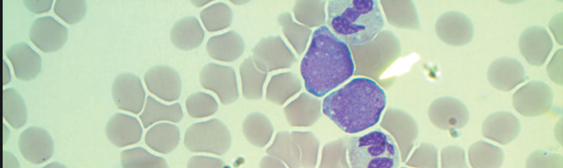 An image of the peripheral blood smear shows four blasts: very large cells with a large immature purple nucleus and small rim of blue cytoplasm.