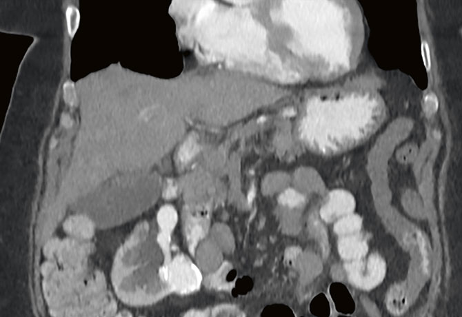 image showing a renal artery aneurysm with the aberrant vasculature