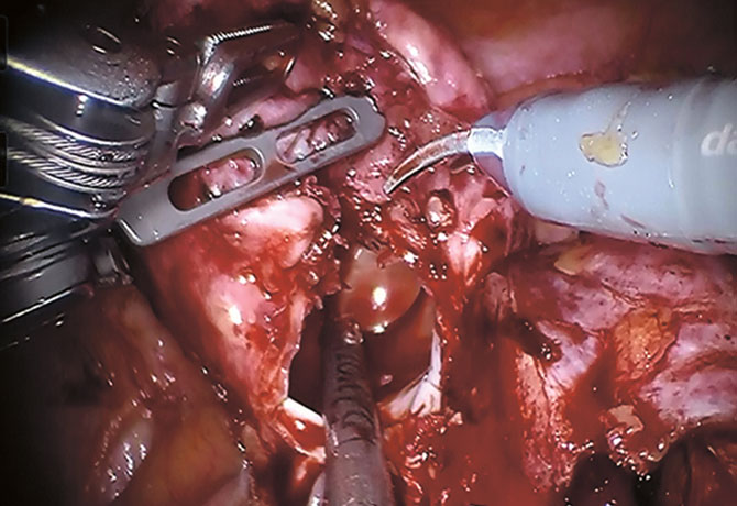 image of the inside of a devascularized aneurysm