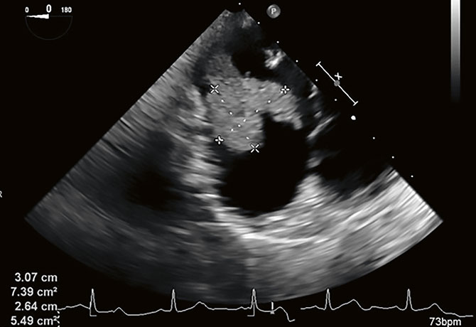 image of an electrocardiogram showing a tumor