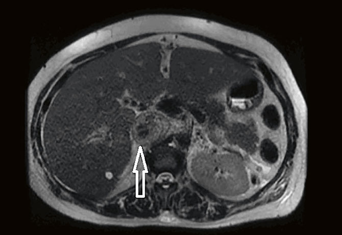 image of mri showing the suprahepatic vena cava tumor extension