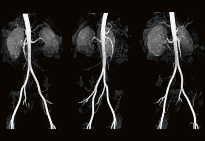 image of a 3D reconstruction of renal arteries
