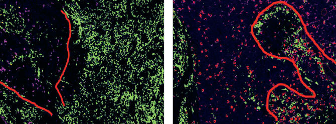 Image of HPV-related tumor and Red-cell infiltration