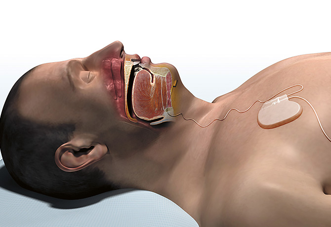Graphic of male sleeping with device